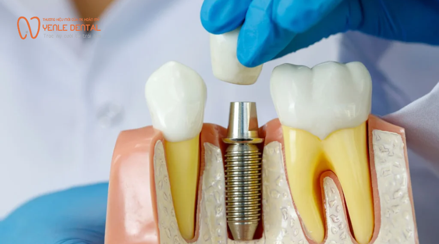 nhổ răng bao lâu thì trồng Implant